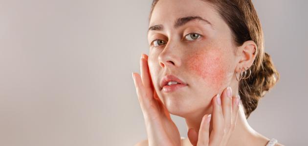 Symptoms of spring allergy skin and ways to treat it